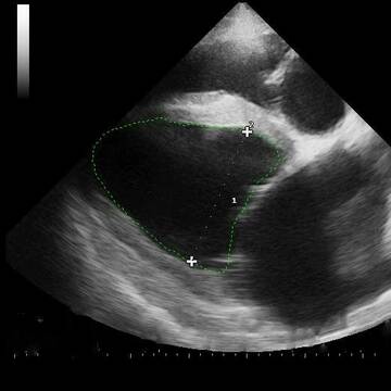 Mobiles Herzultraschall